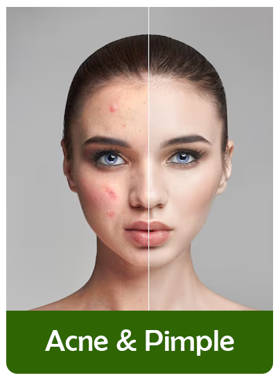 acne pimple treatment